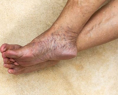 Top-Rated Varicose Veins Doctors in Dubai
