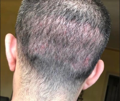 Hair Transplant: Natural Results Without Complications