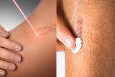 How To Get Laser Scar Removal Safely