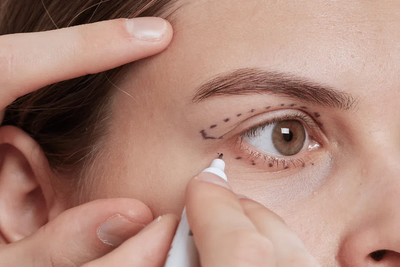 What is Eyelid Surgery (Blepharoplasty)