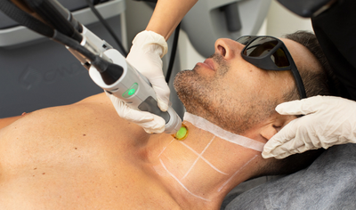 How Many Sessions Are Required for Laser Hair Bleaching