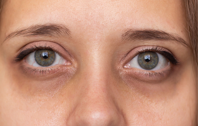 Can Dark Circles Be a Sign of Illness?