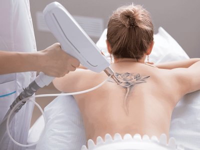 How Many Sessions Are Required for Laser Tattoo Removal?