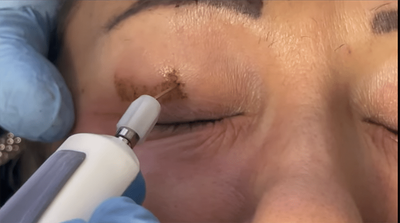 How Many Sessions Are Required for Plexr Plasma Eye Lift