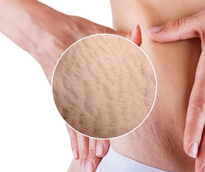 Do Stretch Marks Fade Naturally?