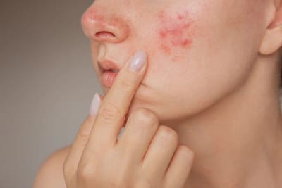 Does Rosacea Get Worse With Age?
