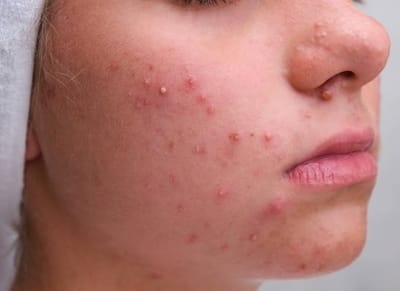 Can Acne Treatments Be Done in Stages?