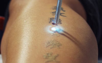 Can Tattoo Removal Improve Career Opportunities?