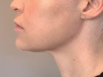 How Soon Do Results Appear After Belkyra Treatment