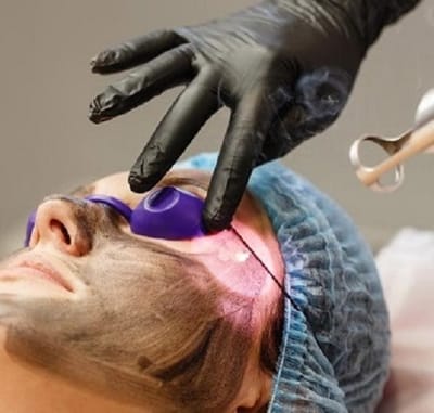Can Spectra Laser Carbon Peel Improve Confidence