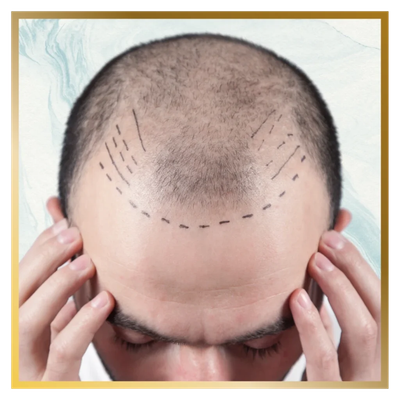 What Are the Advantages of Modern Hair Transplant Techniques?