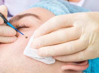 Does Laser Mole Removal Leave Scars?