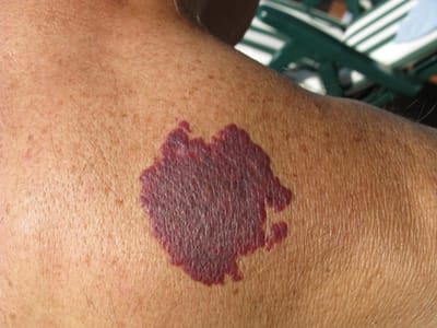 Is Laser Treatment Safe for Birthmarks