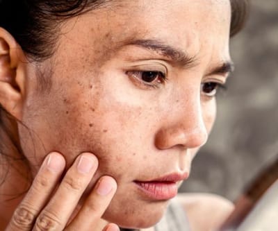 Who Needs Dermal Pigmentation Treatment?
