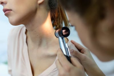 What is Severe Acne Treatment in Dermatology?