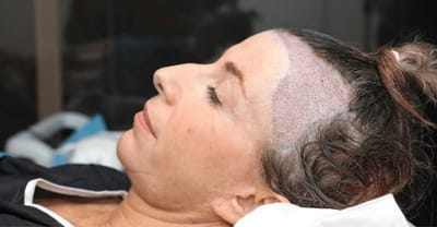 Can Women Get Hair Transplant?