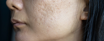 How Does Large Pores Treatment Work?
