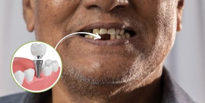 How Long Does Dental Implant Procedure Take?