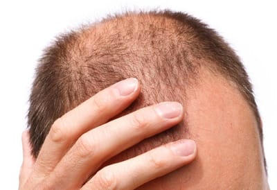 Can a Hair Transplant improve hairline symmetry?
