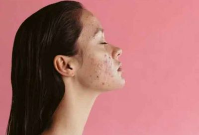 Are consultations necessary before And After Acne Treatment?