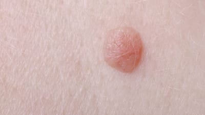 What is Wart Removal?
