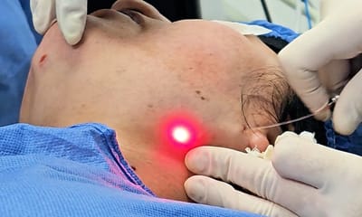 What is the price of Endolift?