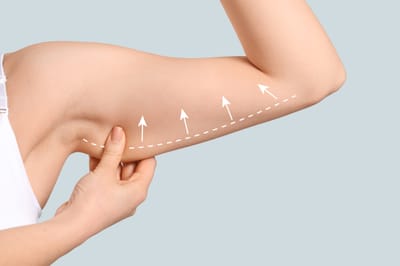 Is Arm Lift Surgery suitable for all body types?