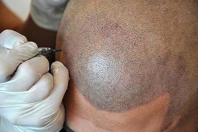 Is Scalp Micropigmentation Treatment safe?