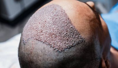 Is Hybrid Hair Transplant a safe procedure?