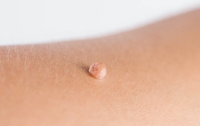 Is Skin Tag Removal Treatment safe?