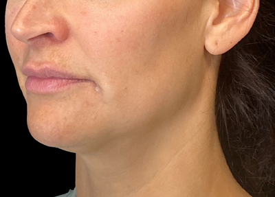 Is Belkyra a non-surgical double chin treatment?