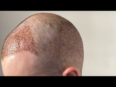 What is the maximum cost of a hair transplant?