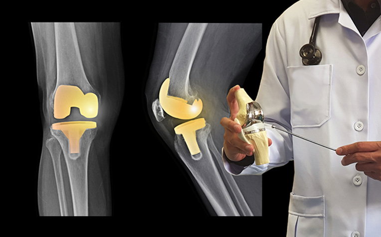 What a Knee Osteoarthritis Doctor in Encino Recommends for Daily Pain?