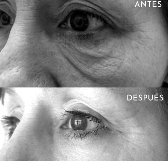 Blefaroplastia sin Cirugía