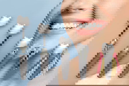 Імплантація системою NeoBioTech