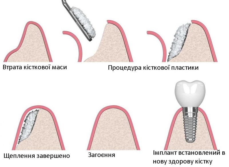Підсадка кісткової тканини