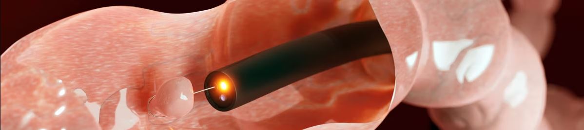 Colonoscopy Screening Singapore