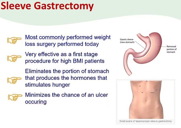 weight loss surgery singapore