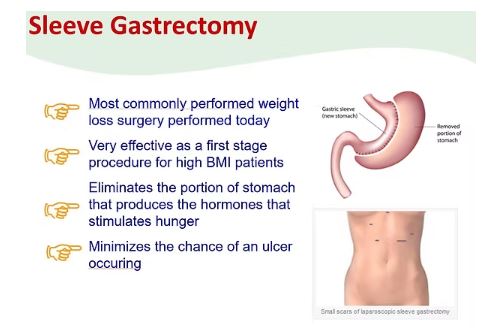 bariatric surgery singapore