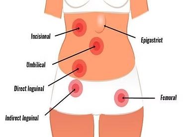 hernia surgery singapore