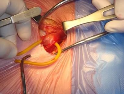 hernia operation cost singapore