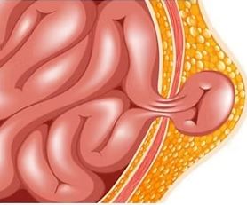 singapore hernia surgeon rates