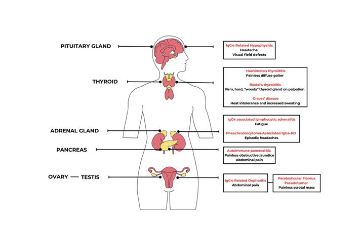 IgG4-Related Disease: Endocrine Involvement, Clinical Implications, and Management Strategies