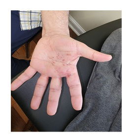 A Rare Case of Herpes Zoster with C7 Involvement Mimicking Dermatitis: An Elusive Diagnosis