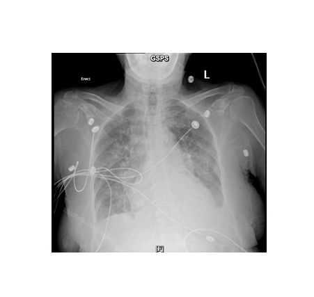 Acetazolamide Use in the Management of Refractory Acute Decompensated Heart Failure in the ICU