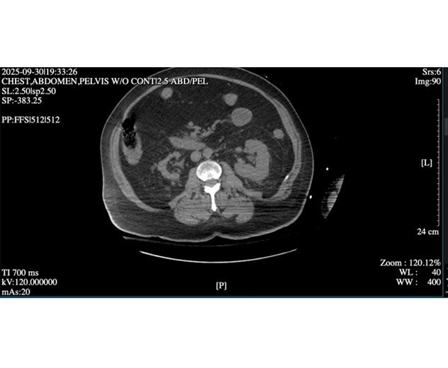 Metformin Toxicity Unmasked by Obstructive Uropathy: A Case of Metformin Associated Lactic Acidosis and Euglycemic Diabetic Ketoacidosis
