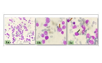 Unrevealing the Epigenetic Landscape: SOX-2 and OCT-4 methylation in acute myeloid leukemia and myelodysplastic neoplasm