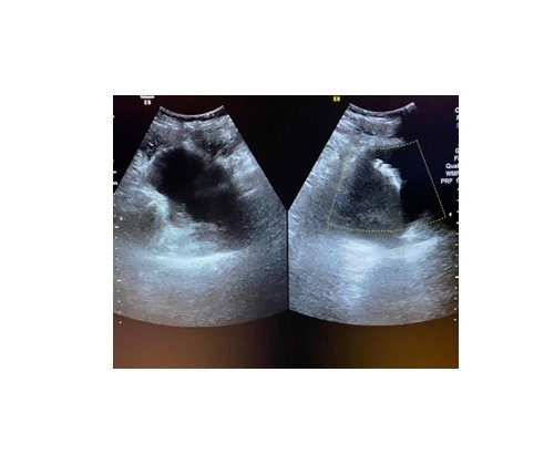 Intravesical Mesh Migration After Hernia Repair: A Case Report