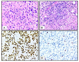 Clinicopathological Features and Outcomes of H3K27-Altered Diffuse Midline Gliomas: An Immunohistochemistry-Based Study from a Tertiary Cancer Centre in Western India