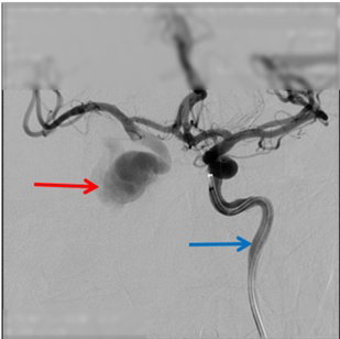 Echoes of Trauma: DSA-Guided Coil Embolization for Carotid Cavernous Fistula Presenting with Ocular Bruit and Pulsatile Exophthalmos
